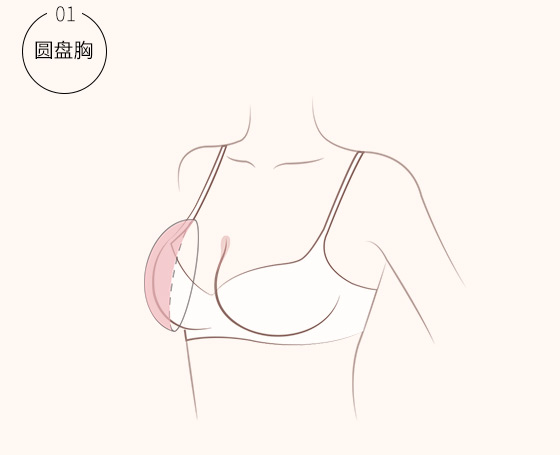 圆盘胸介绍